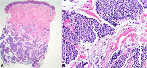 Skin punch biopsy of the lower portion of the left side of the back. A,... | Download Scientific ...