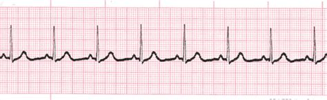 Normal Sinus Rhythm - EKG Lesson #313