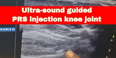 Ultrasound-guided PRP injection knee joint Chennai India