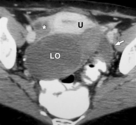 CT Features of Adnexal Torsion | AJR