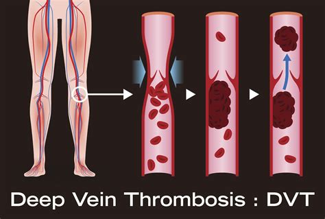 Travel and Deep Vein Thrombosis (DVT) - Health Beat