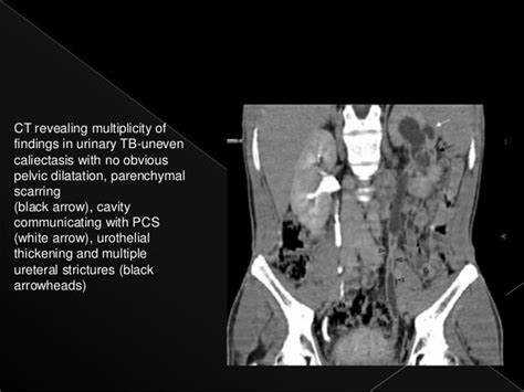 Renal tuberculosis radiology