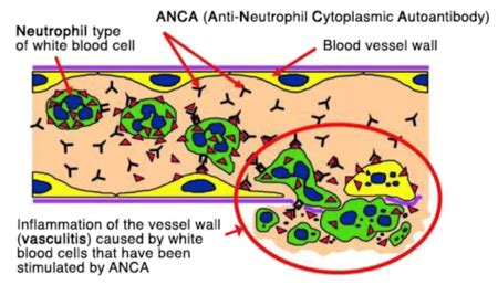 What is ANCA? - Vasculitis UK