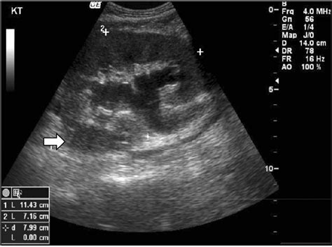 Kidney Ultrasound