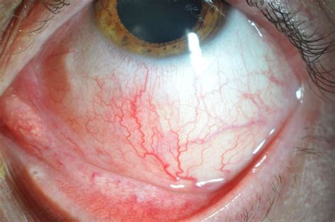 Images in ophthalmia nodosa: an unusual presentation of red eye | BMJ ...