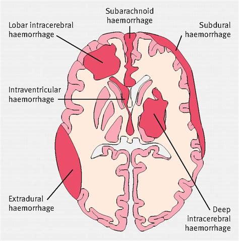 Bleeding Within Meninges and How to Treat It – Platform | CME