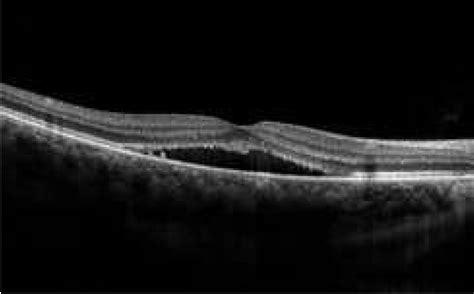 Central Serous Choroidopathy - Macula Retina Vitreous Center