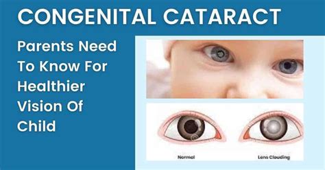 Congenital Cataract: Parents need to know - EyesOPT