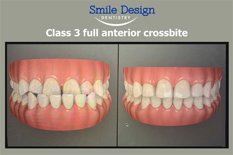 Best Invisalign® Smile Corrections in Plymouth, MN