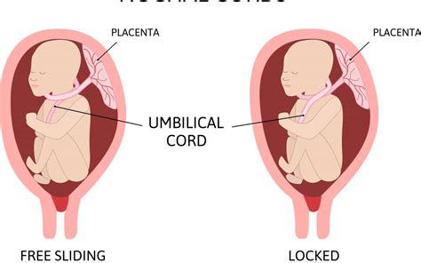 Nuchal Cord And HIE Two Cord Patterns When Around The Baby’s Neck - HIE ...