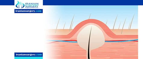 Pilonidal cyst surgery recovery wound - Iranian Surgery