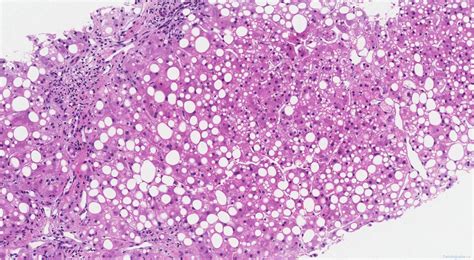 Steatosis | Atlas of Pathology