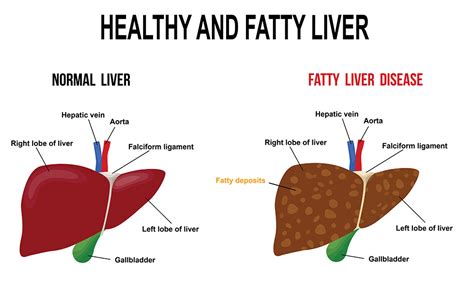 9 Useful Functions of the Liver and Common Type of Fatty Liver – Causes, Symptoms & Care ...