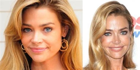 Denise Richards before and after plastic surgery 41 – Celebrity plastic ...