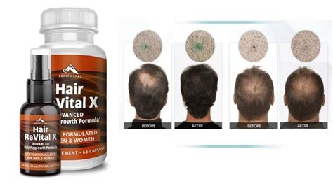 Hair Revital X Review - 100% Healthy Hair Regrowth Formula