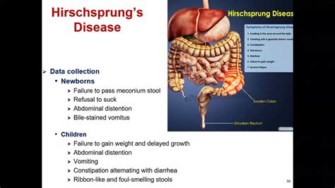 Hirschsprung Disease - Pediatrics Gastroenterology - YouTube