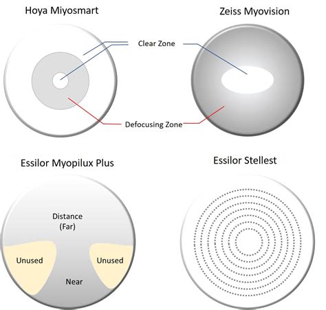 Children Myopia Control and Orthokeratology | Berlin Optical