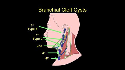 Branchial Cleft Cyst Diagram - vrogue.co