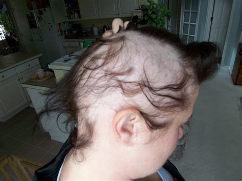 Medical Pictures Info – Alopecia Areata