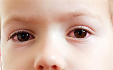 Pink eye in toddlers: Symptoms, diagnosis, and treatment