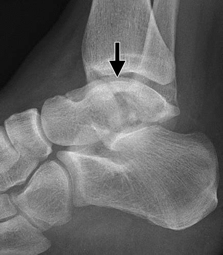 Talar Fractures and Dislocations: A Radiologist’s Guide to Timely Diagnosis and Classification ...