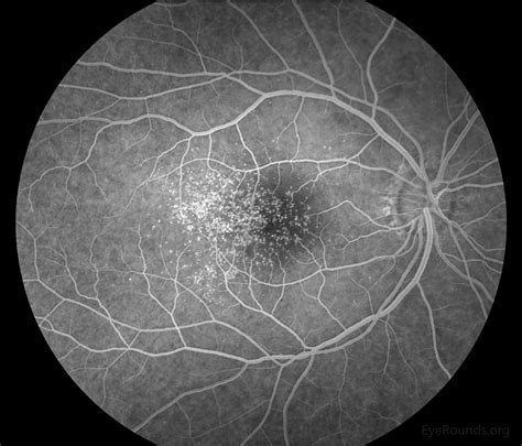 Early onset macular drusen and C3 glomerulopathy (formerly type II ...