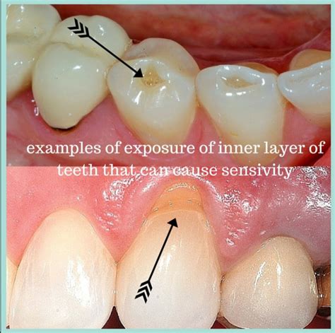 Understanding Tooth Sensitivity | Palms Dentist, Shirley Christchurch Dentists