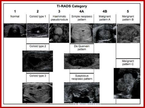 TIRADS (thyroid nodule imaging reporting and data system) Dr Ahmed E…