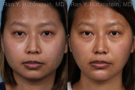 Botox Photos | Newburgh, NY | Patient 17908