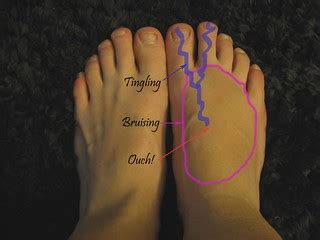 Top Of Foot Pain: Causes and Home Treatment!