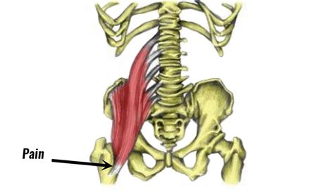 What You Need To Know About Iliopsoas Release Surgery