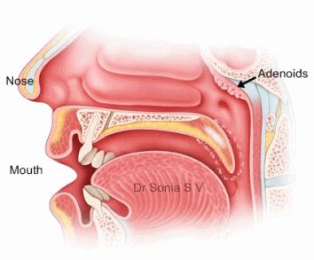 Adenoids - Dr Sonia's ENT