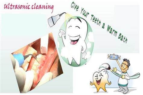 Teeth Scaling(cleaning and polishing) – Kholood Dental Clinic