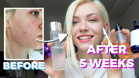 🧖🏼‍♀️ How I got rid of ACNE with KOREAN SKINCARE - YouTube