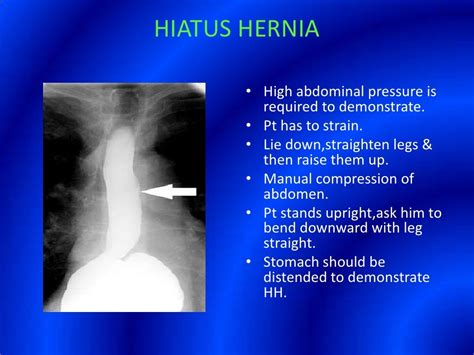 Barium Swallow Presentation