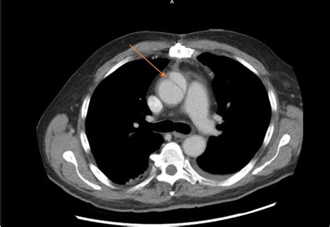 Cureus | Successful Medical Management of an Acute Ascending Aortic Dissection After Coronary ...