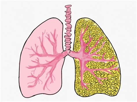 Popcorn Lung: Health Risks and Other Side Effects Surrounding Vaping – Minnetonka Breezes