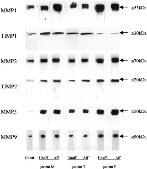 Western blotting: Immunodetection of MMP-1, MMP-2, MMP-3, MMP-9 ...