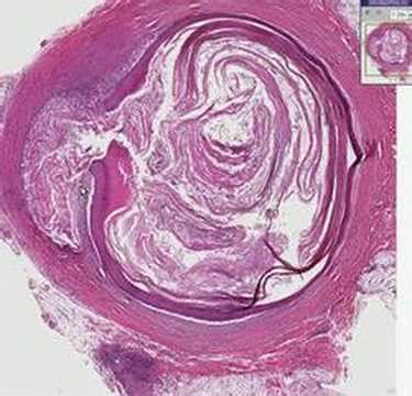 Histopathology Skin--Epidermal inclusion cyst - YouTube