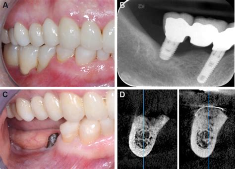 Free gingival graft in two-stage guided bone regeneration procedure ...