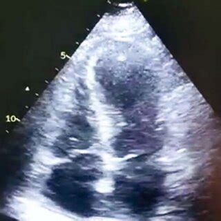 Figure nr. 1. Echocardiography -four chambers apical view showing the ...