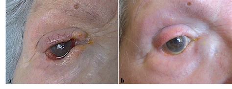 Figure 1 from Treatment of ocular cicatricial pemphigoid with the tumour necrosis factor alpha ...