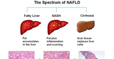 Non alcoholic fatty liver disease causes | How To Get Daily