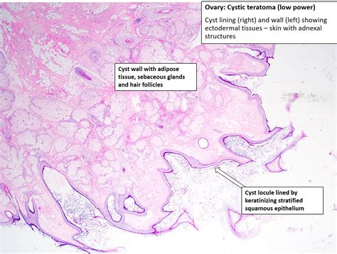 Teratoma Histology