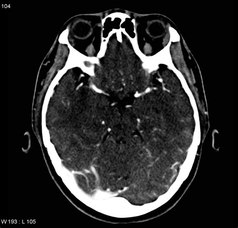 Cerebral venous sinus thrombosis CT - wikidoc