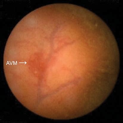 Video capsule endoscopy shows an AVM in the terminal il | Open-i