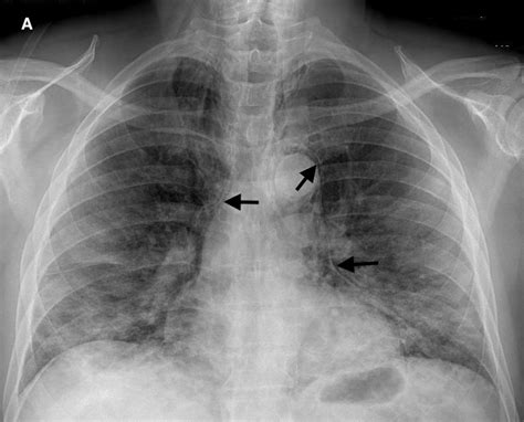 COVID-19 Pneumonia Associated With Spontaneous Pneumomediastinum and Pneumopericardium | CTSNet