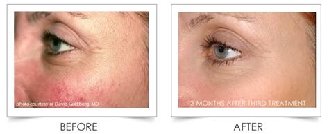 Columbia Laser Skin Center Laser Genesis - Scars, Large Pores, Skin ...