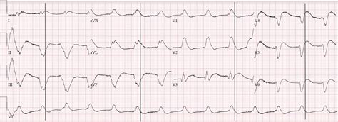 Dr. Smith's ECG Blog: Shark Fin morphology recognized only by EM physician