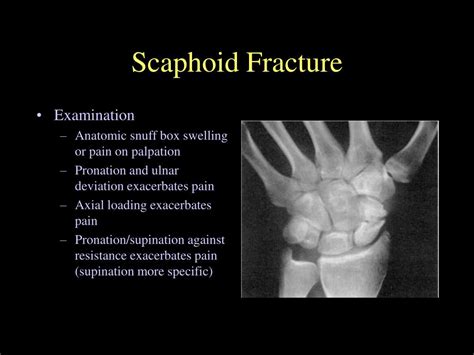 PPT - Management of Extremity Fractures PowerPoint Presentation, free download - ID:182329